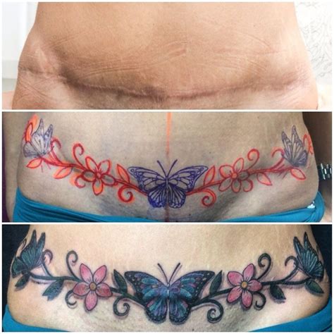 Abdominoplasty Scar Tattoo