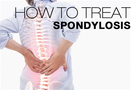 Spondylosis Symptoms Causes Treatment By Back Braces Spondylosis Symptoms Causes Treatment By Back Braces