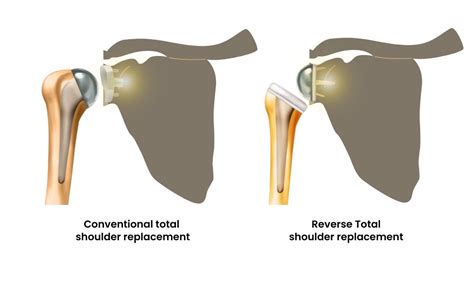 Total Shoulder Replacement Amp Reverse Shoulder Replacement Numed Hospital Total Shoulder Replacement Amp Reverse Shoulder Replacement Numed Hospital