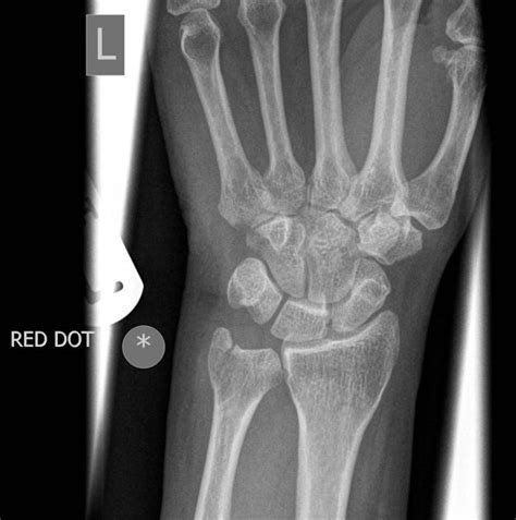 Ulnar Styloid Fracture Radiology Reference Article Radiopaedia Org